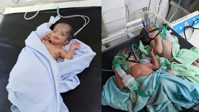 أنجبت 3 توائم.. ولادة قيصرية لمريضة كورونا بمستشفى ناصر ببني سويف (صور)